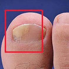 Mycosis nebo nehtová houba