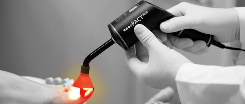 laserové ošetření plísní na nehtech